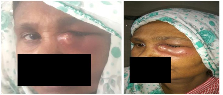 A case of acute dacrocystitis with abscess and orbital cellulitis: An ophthalmic emergency