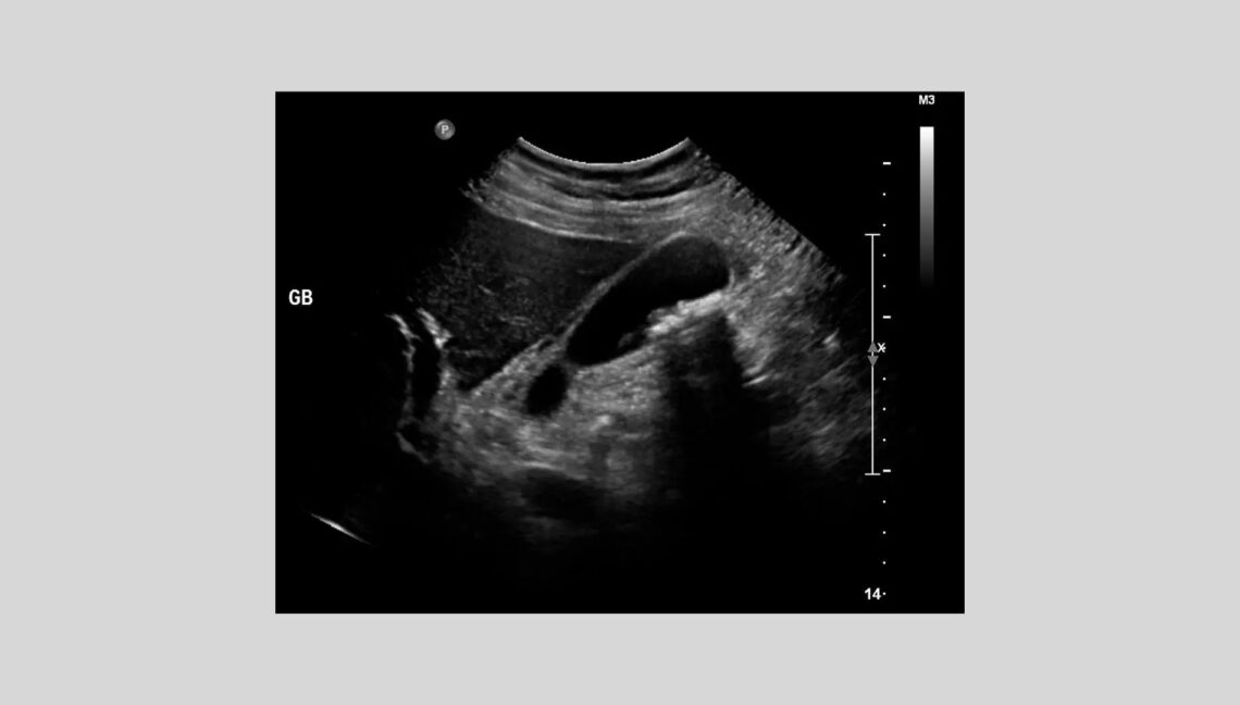 Hospitalisation and Homeopathic Management of Acalculous Cholecystitis