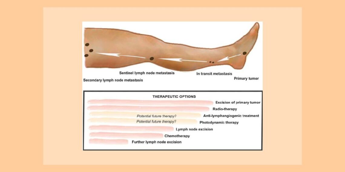Siicea -A Non Excisional Therapeutic for Lymphadenopathy