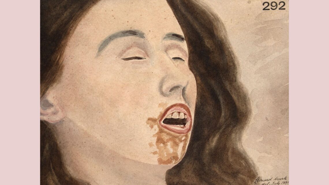 Carbolic Acid Poisoning and Tautopathy